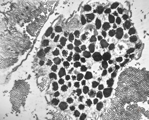 F,23y. | mast cell - n. suralis, demyelinating neuropathy F,23y. | mast cell - n. suralis, demyelinating neuropathy